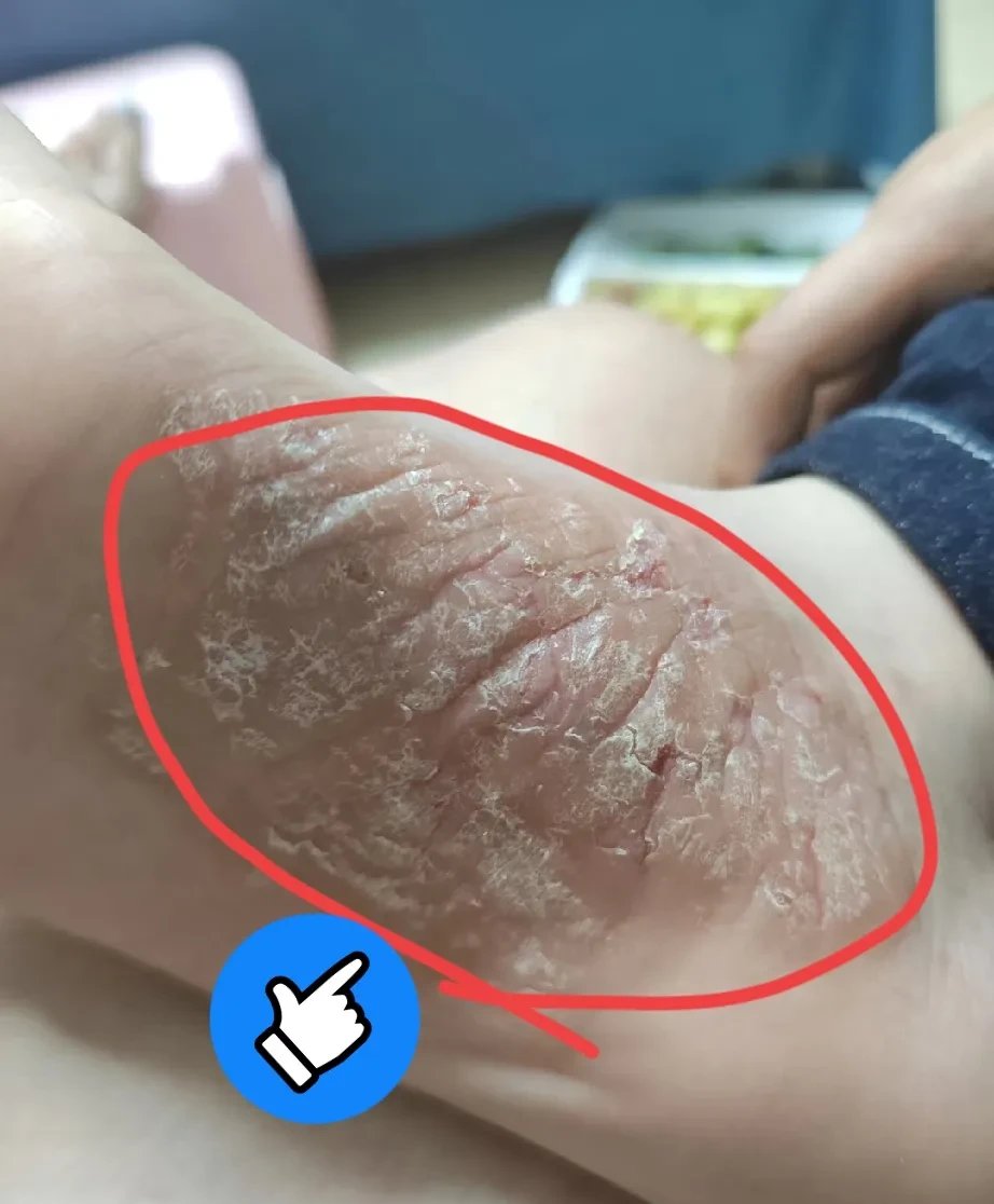 脚上神经性皮炎图片脚皮肤病图片对照大全 查看图片