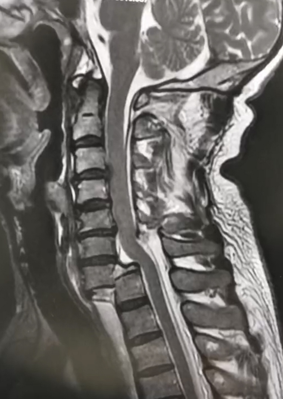 颈椎骨折术后恢复正常行走,生活.