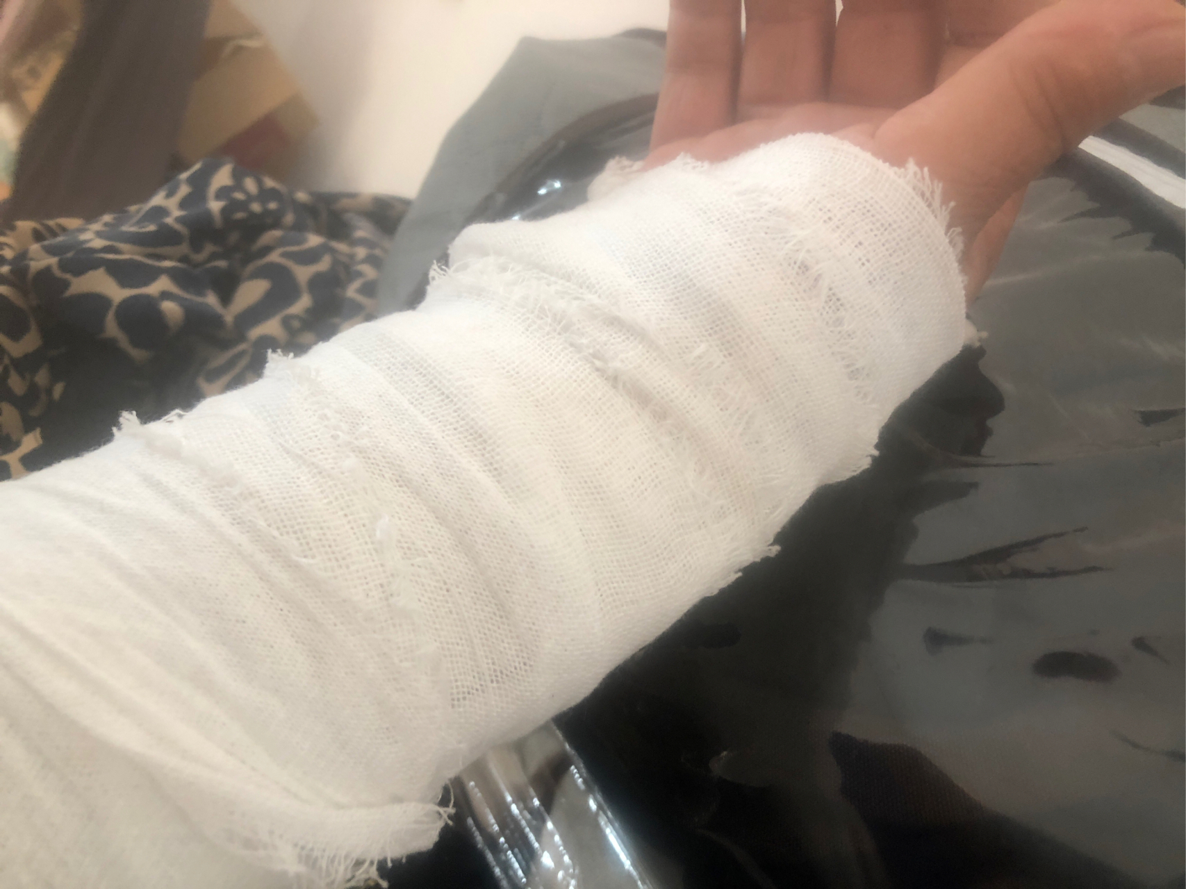 手腕骨折快一个月了,终于熬过了最痛苦的日日夜夜,想想过去的十几天