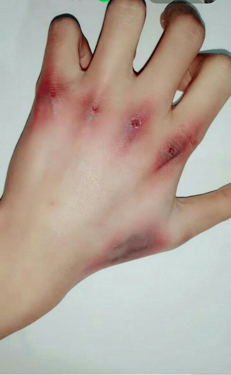 我的手[流泪],很疼的