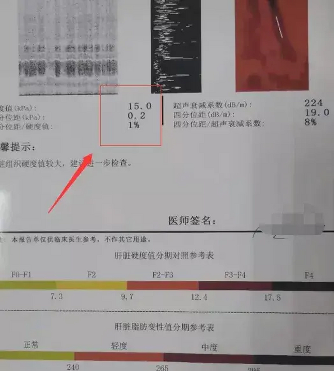 今天的这位患者咨询,在当地医院检查查出肝硬度值已达15,听医生讲超过