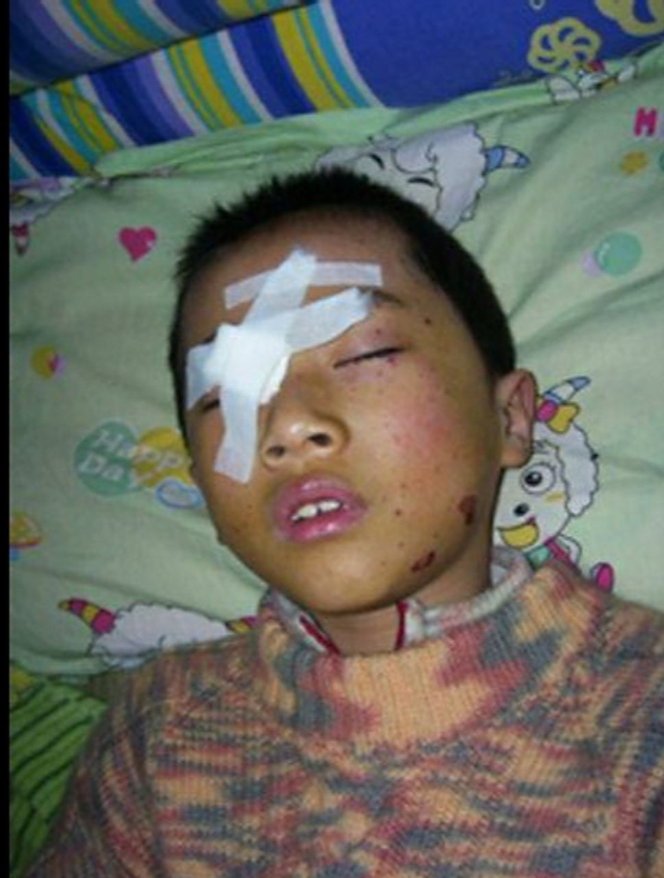 七八岁的孩子眼睛被炸瞎,小心每家都有 你看看一个七八岁的孩子眼睛被