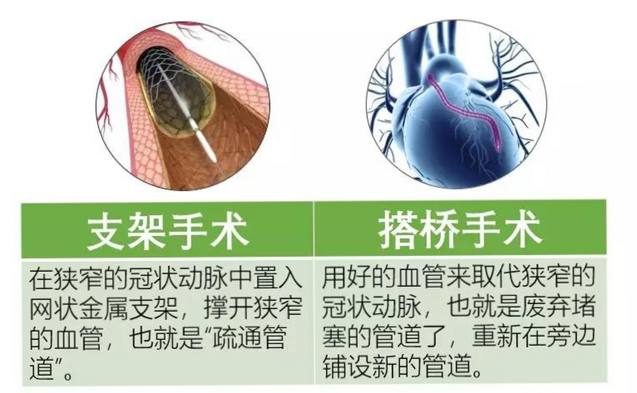 冠心病放支架图片图片