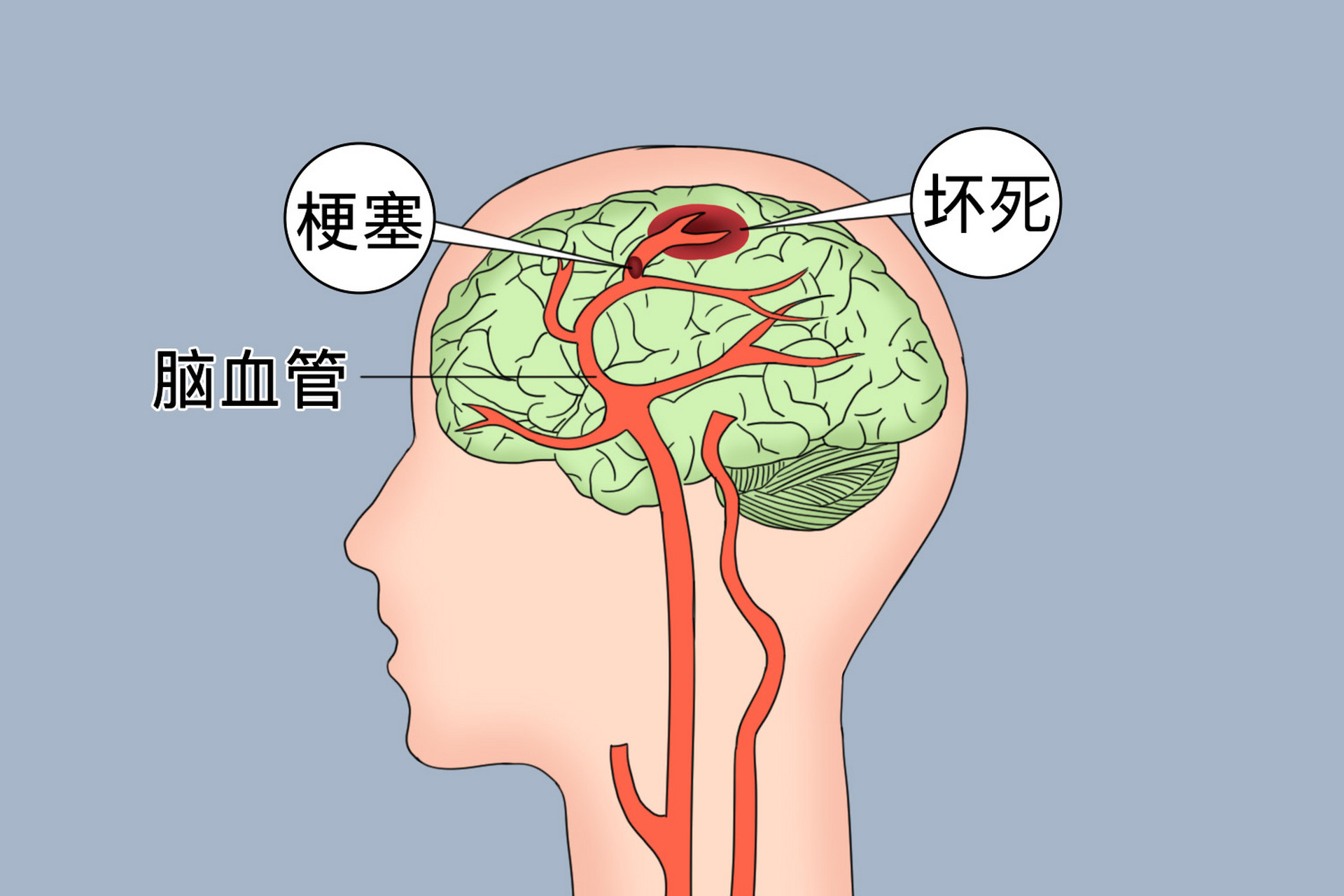 的脑血栓,主要是颅内外供应脑部的动脉血管壁在一些病理改变的情况下