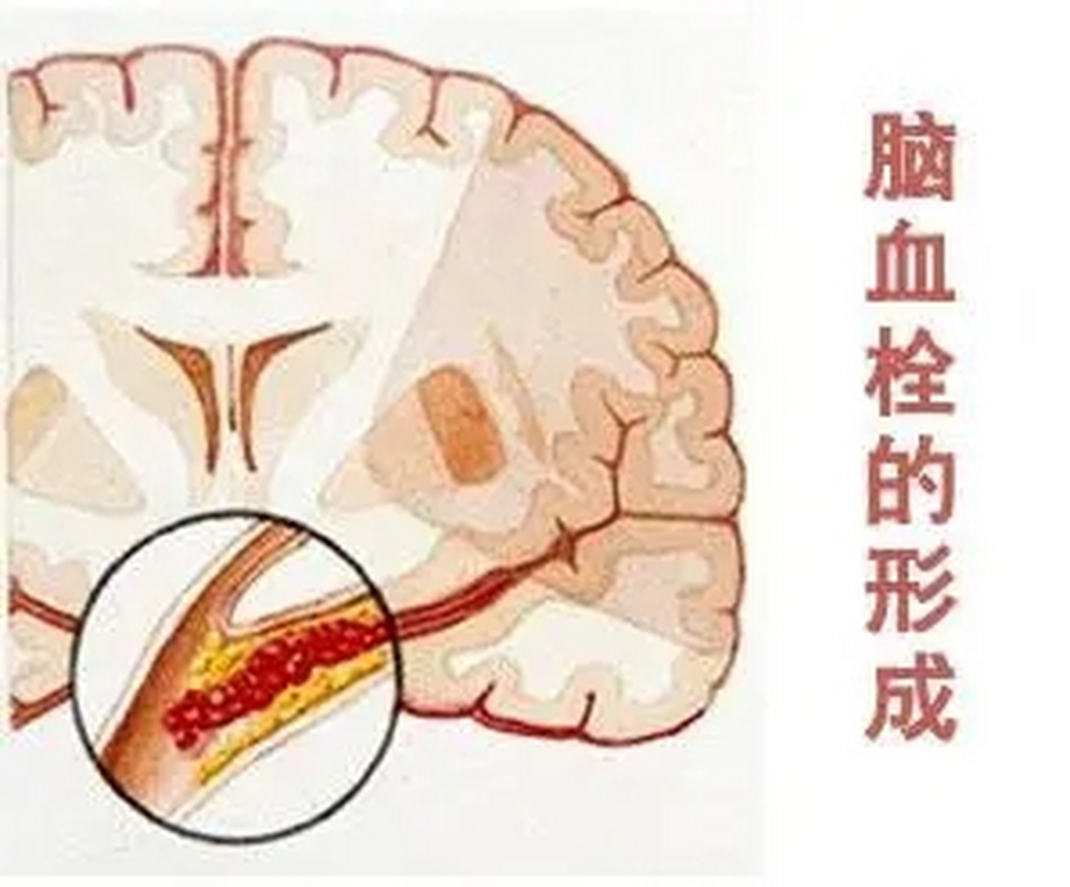 的脑血栓,主要是颅内外供应脑部的动脉血管壁在一些病理改变的情况下