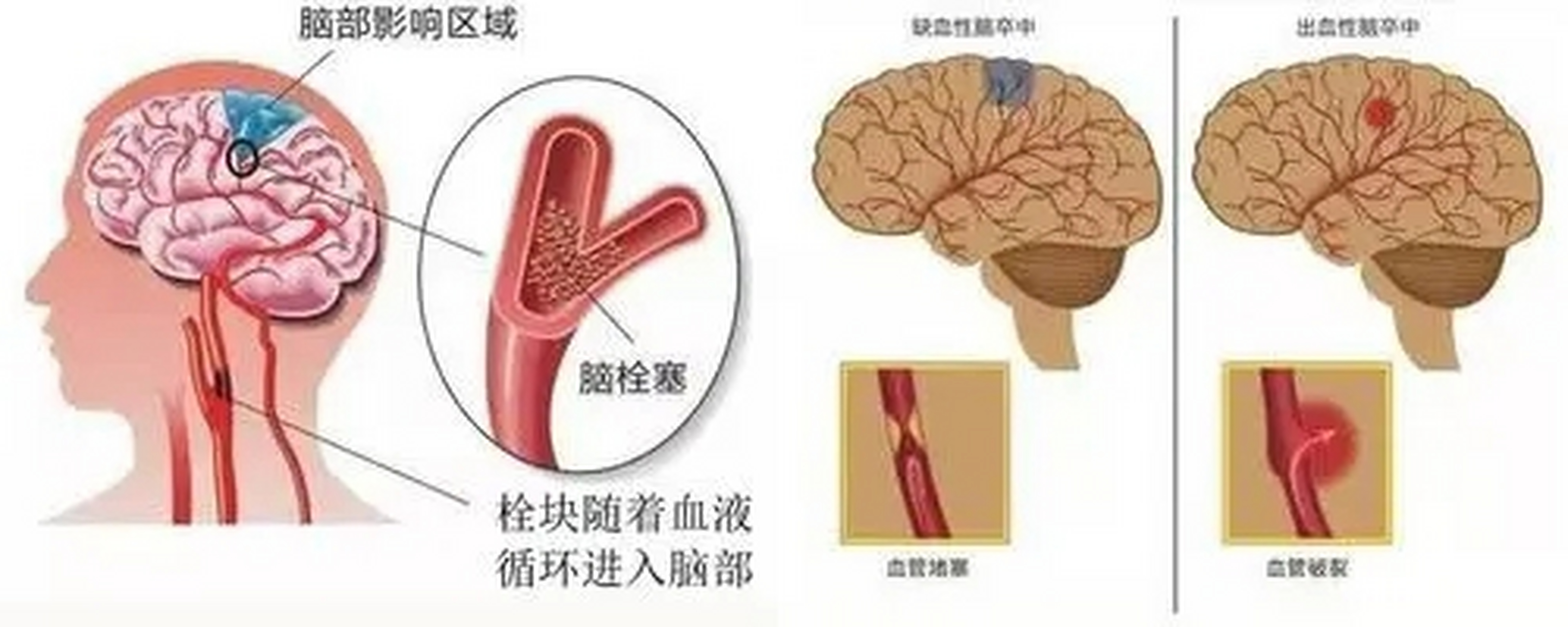 脑血管堵塞相信很多人并不陌生,这也是我们常说的脑血栓,主要是颅内