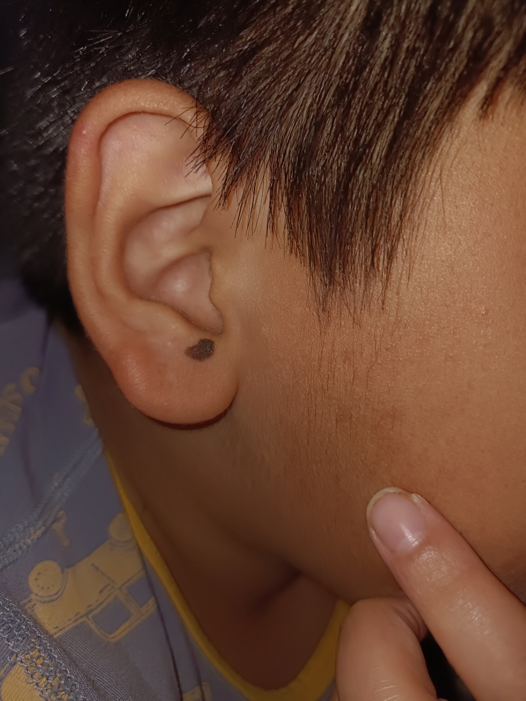 男孩子耳朵这个位置张痣好不好,有个大夫说让点去,有没有懂的朋友