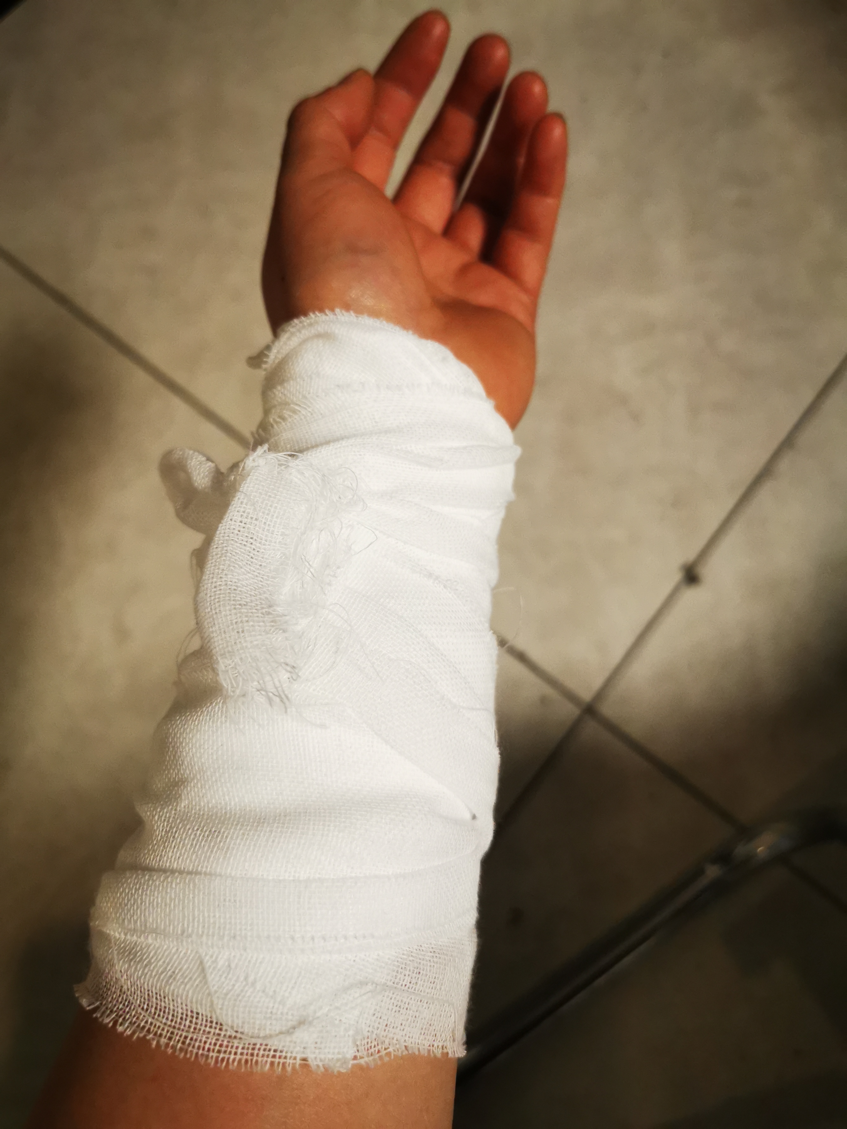 河南省第二人民医院急诊门诊,医生让用凉水冲半个小时,然后抹的药包扎