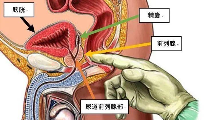 前列腺位于膀胱下方,紧邻直肠,当发生炎症时,前列腺的肿胀可能会压迫