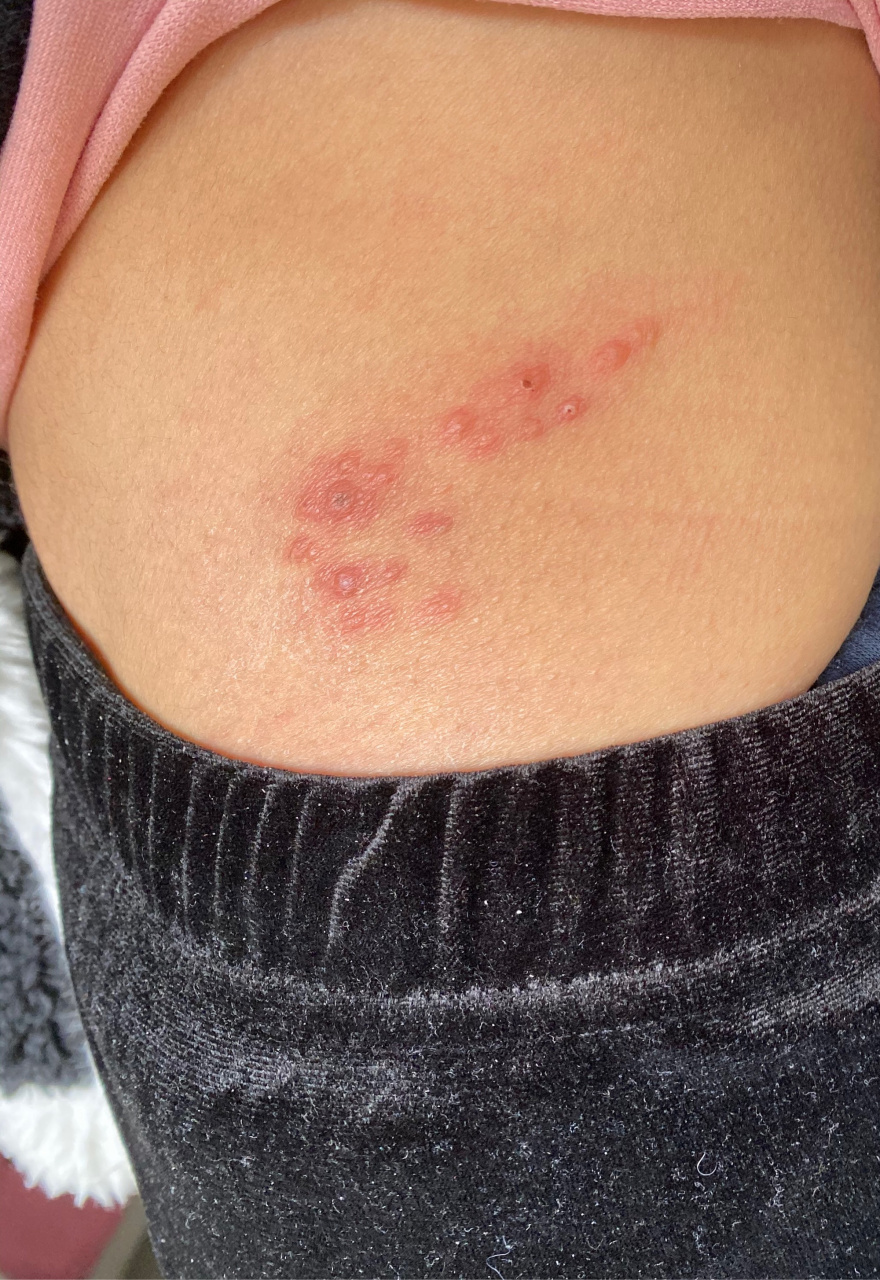 腰那里长了这个,有一点痒,被我挠破了一点黑色结痂,其他没有针状,私