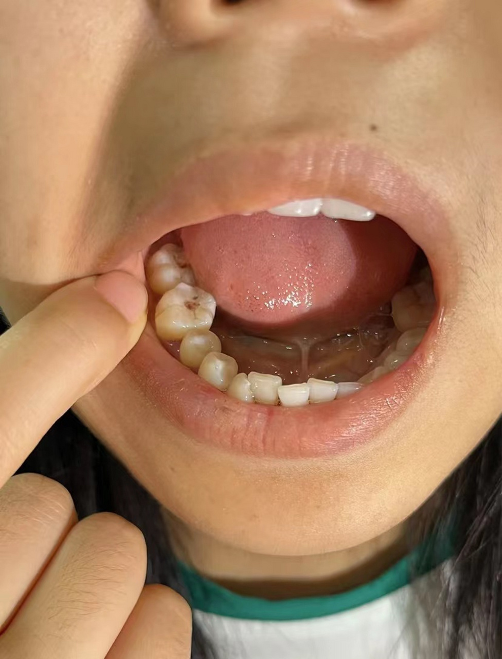 我前段时候牙老是疼,去口腔科拔智齿,我和99697115聊天的时候