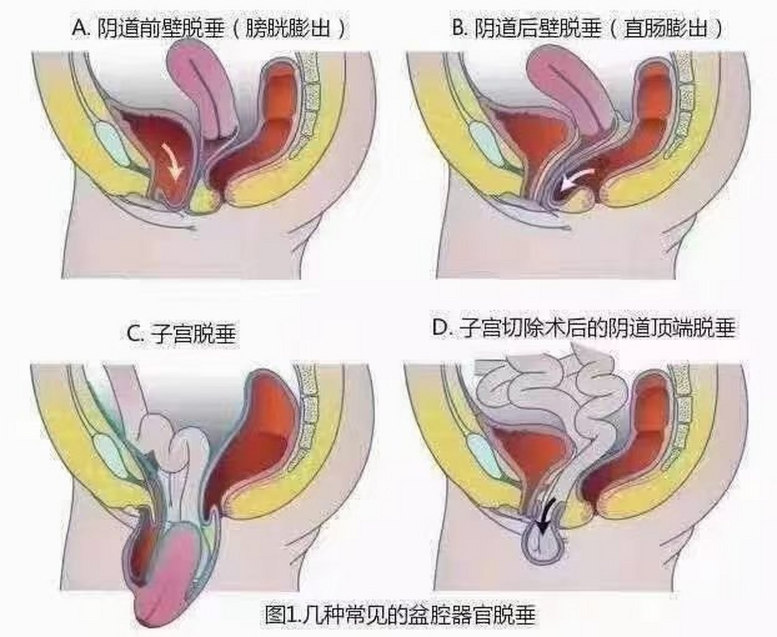 女性健康 脏器脱垂几种常见表现 阴道前壁膨出 阴道后壁膨出 子宫