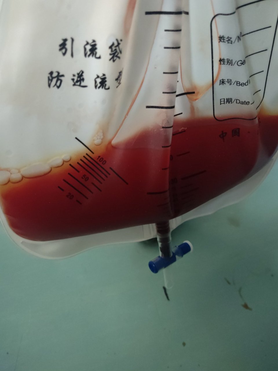 来看看胸腔积液是什么颜色的?