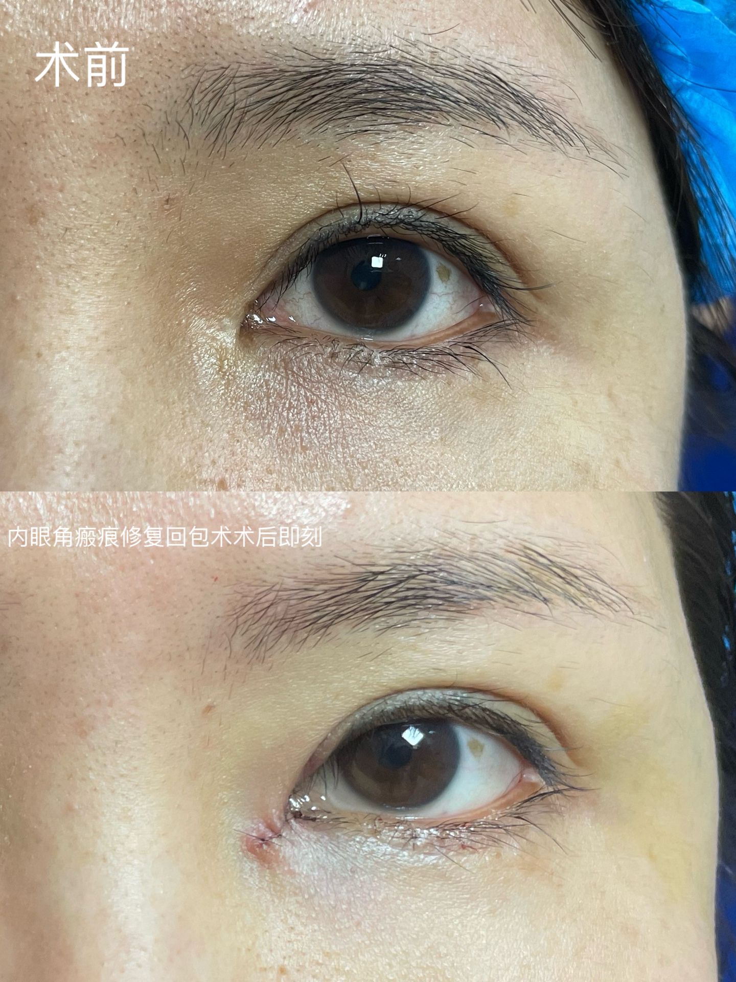 内眼角瘢痕修复回包