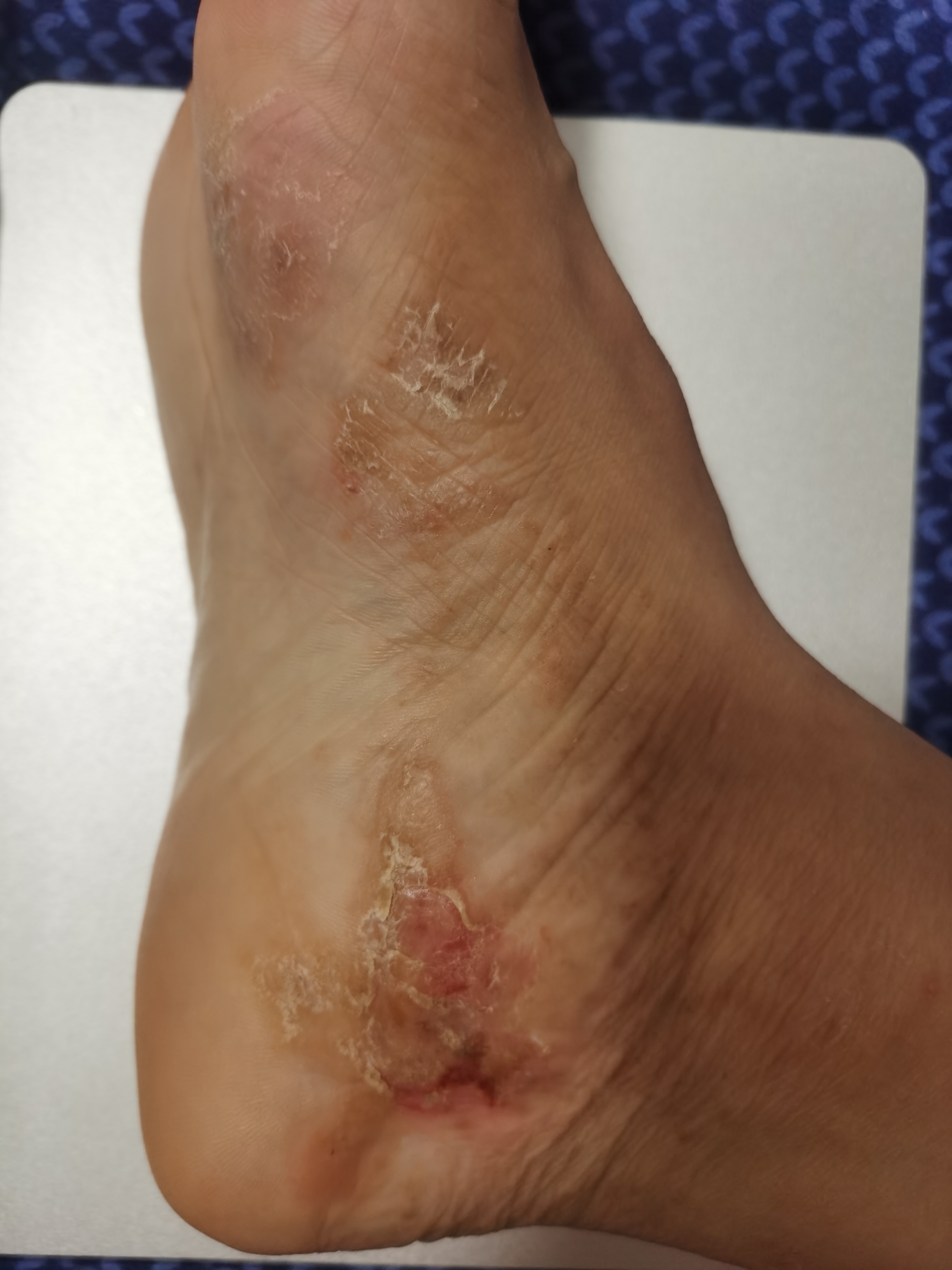 脚部湿疹求助 脚部湿疹一到秋冬就犯病,起水泡,痒,并且脱皮,干裂,只此