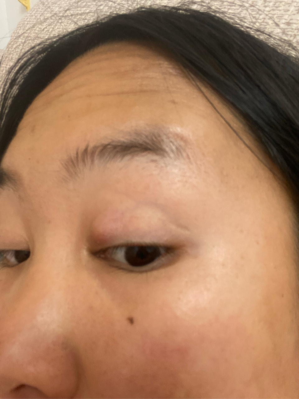 眼睛里长了个圆疙瘩怎么办?求助