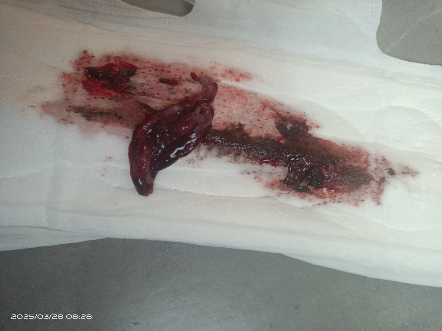 谁能帮我看看这个是流出来的孕囊?