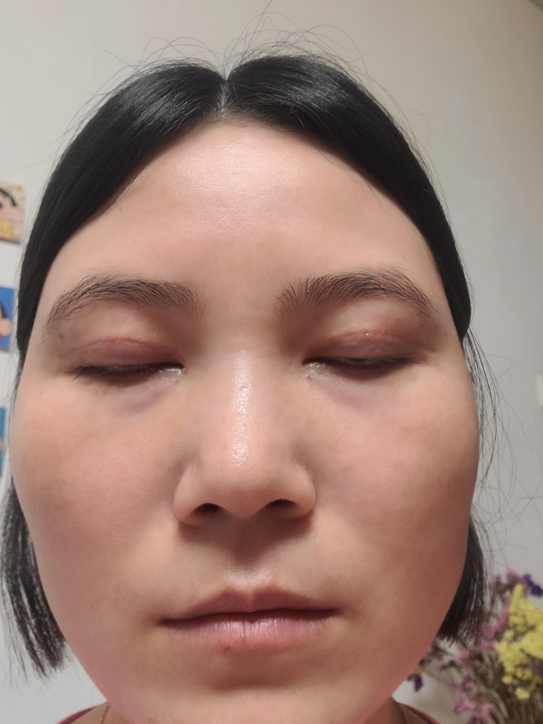做双眼皮跟毁容是的,万万没想到我的初眼做坏了,无良医生,没有医德