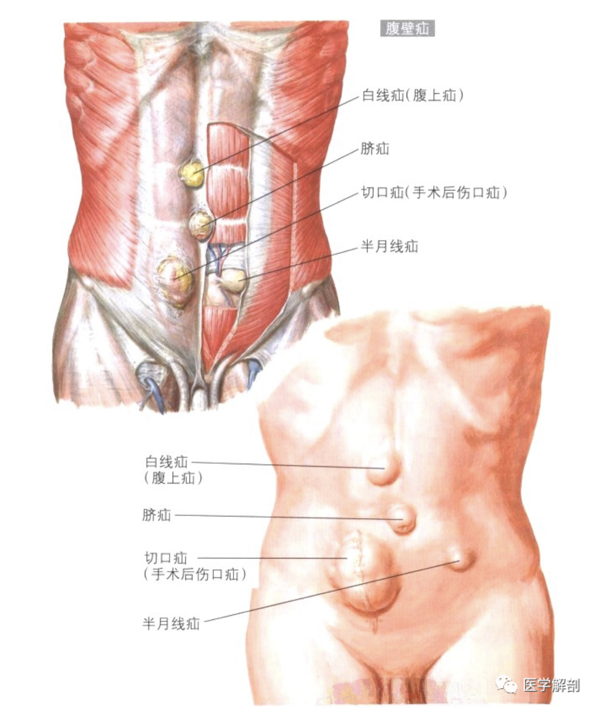 半月线疝位置图片图片