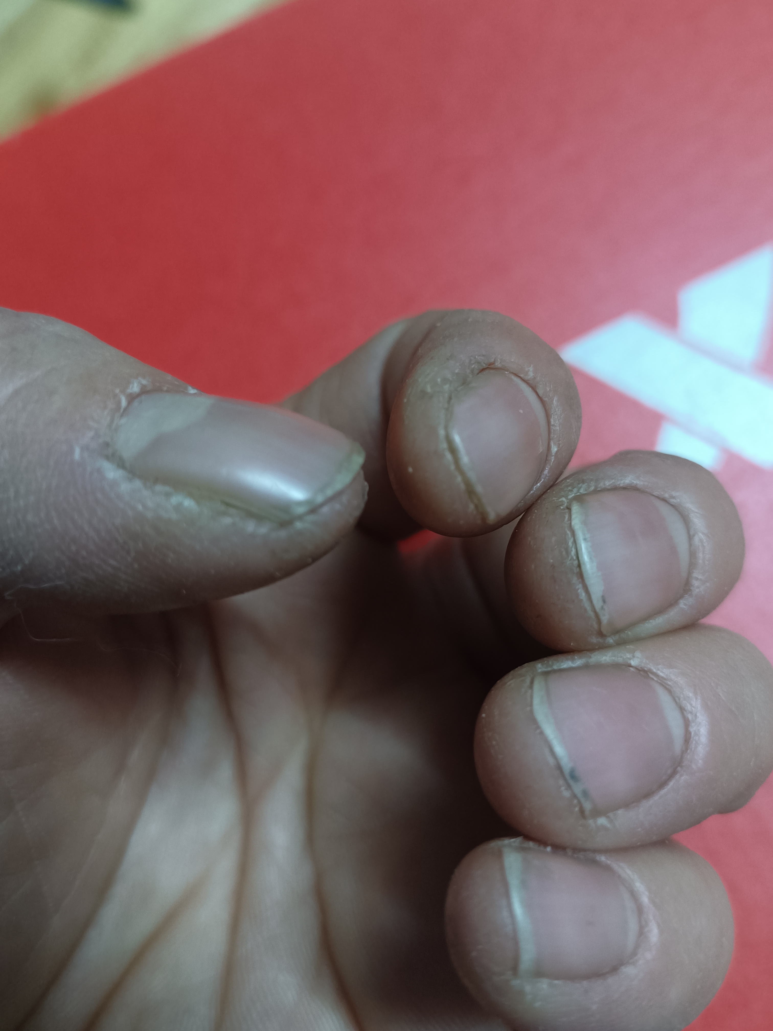 每到冬天,手指甲盖缝都开裂特别痛,用了很多护手霜都没有效果,有没有