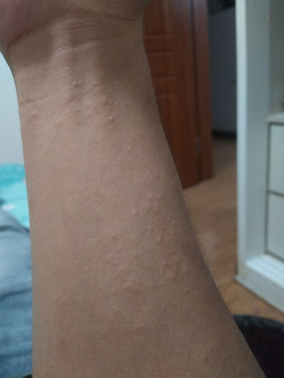 为什么胳膊上有小疙瘩一片一片的为什么在线