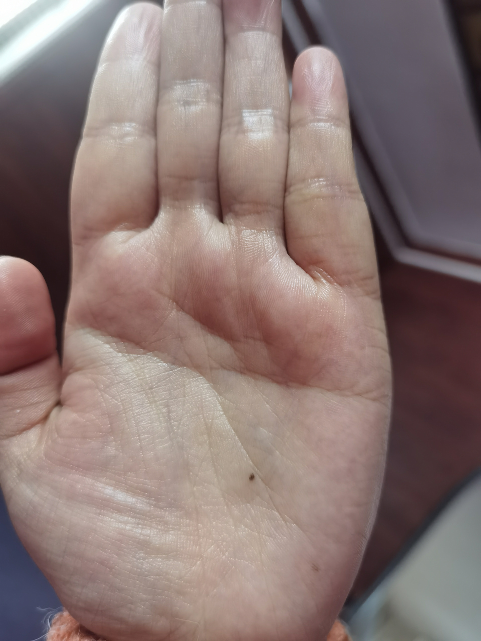 左手掌长痣啥意思?