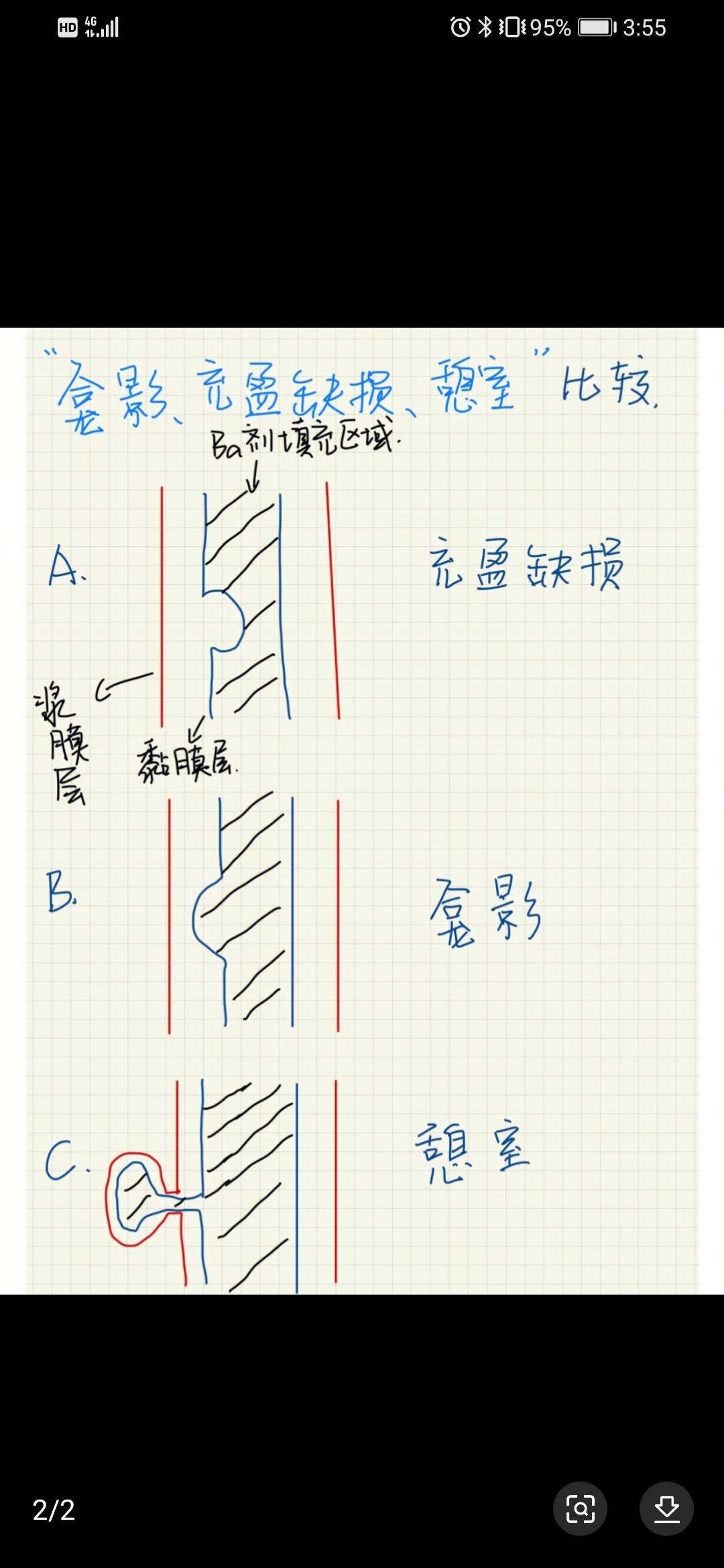 憩室与龛影的区别图片