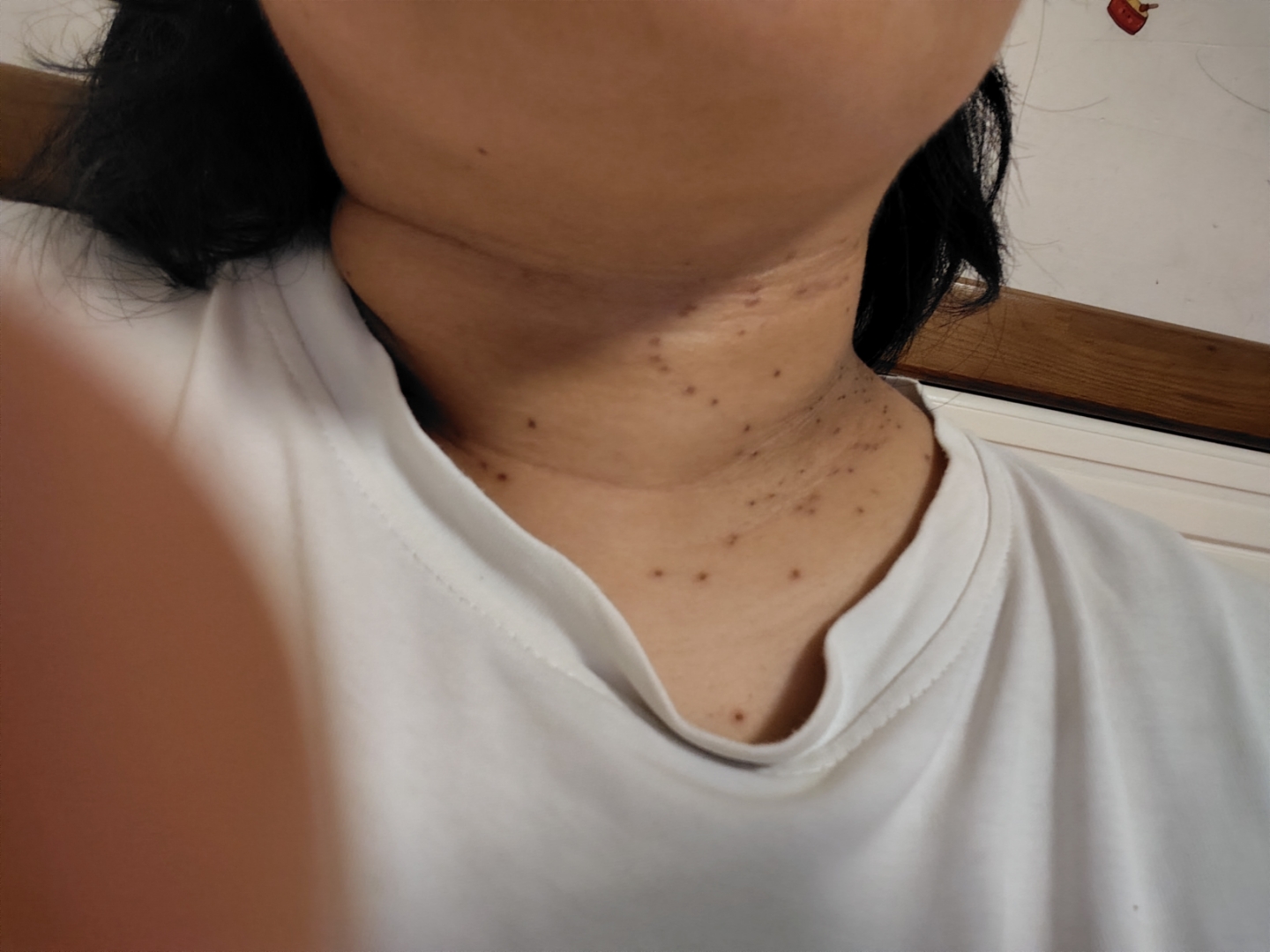 激光去疣一星期,小血痂长得还是蛮结实的