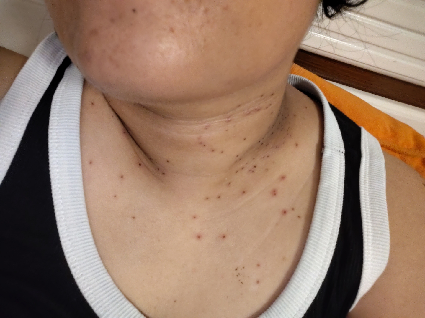 激光去疣第四天,期待十天后去血痂