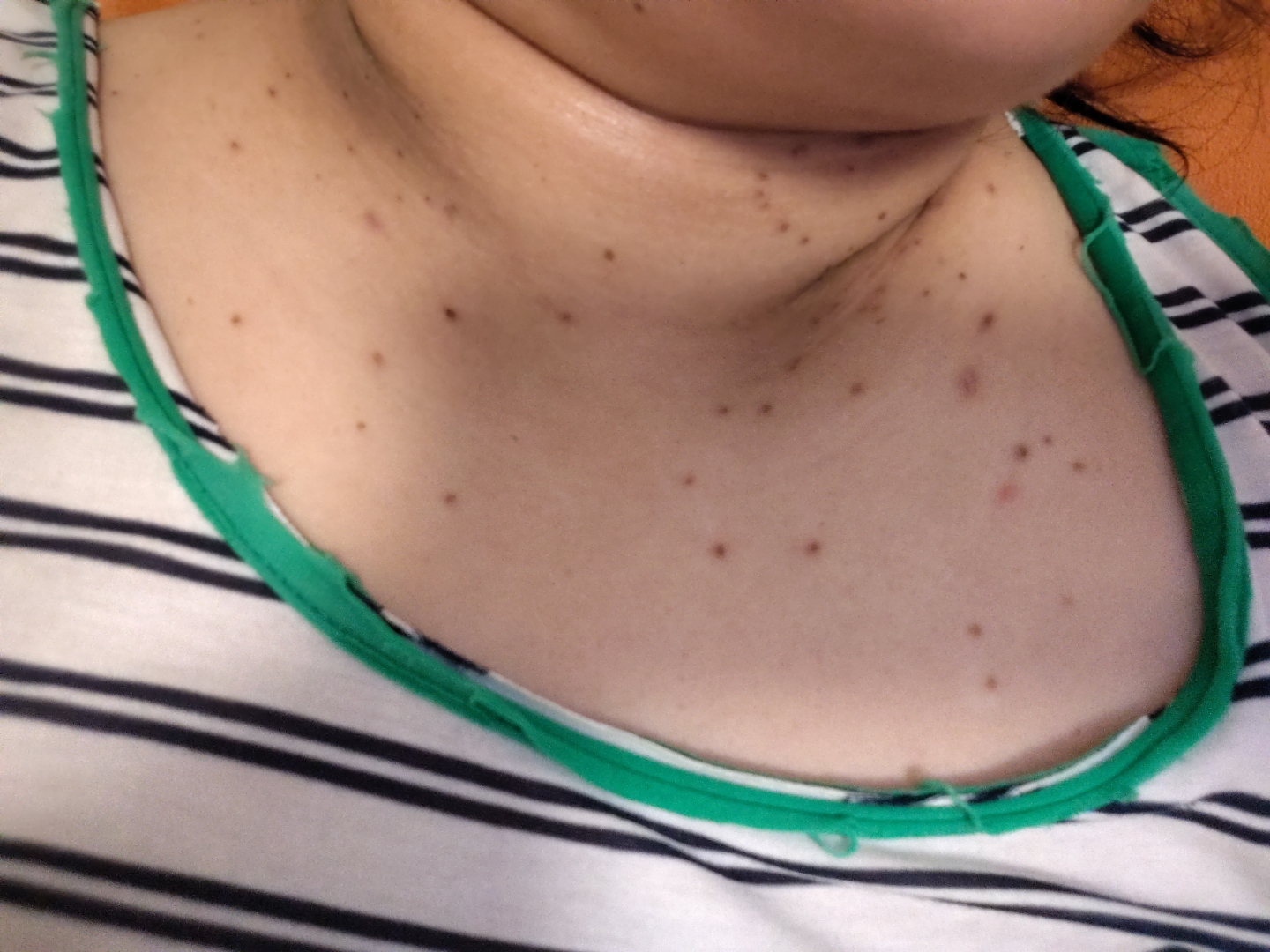 激光去疣第九天