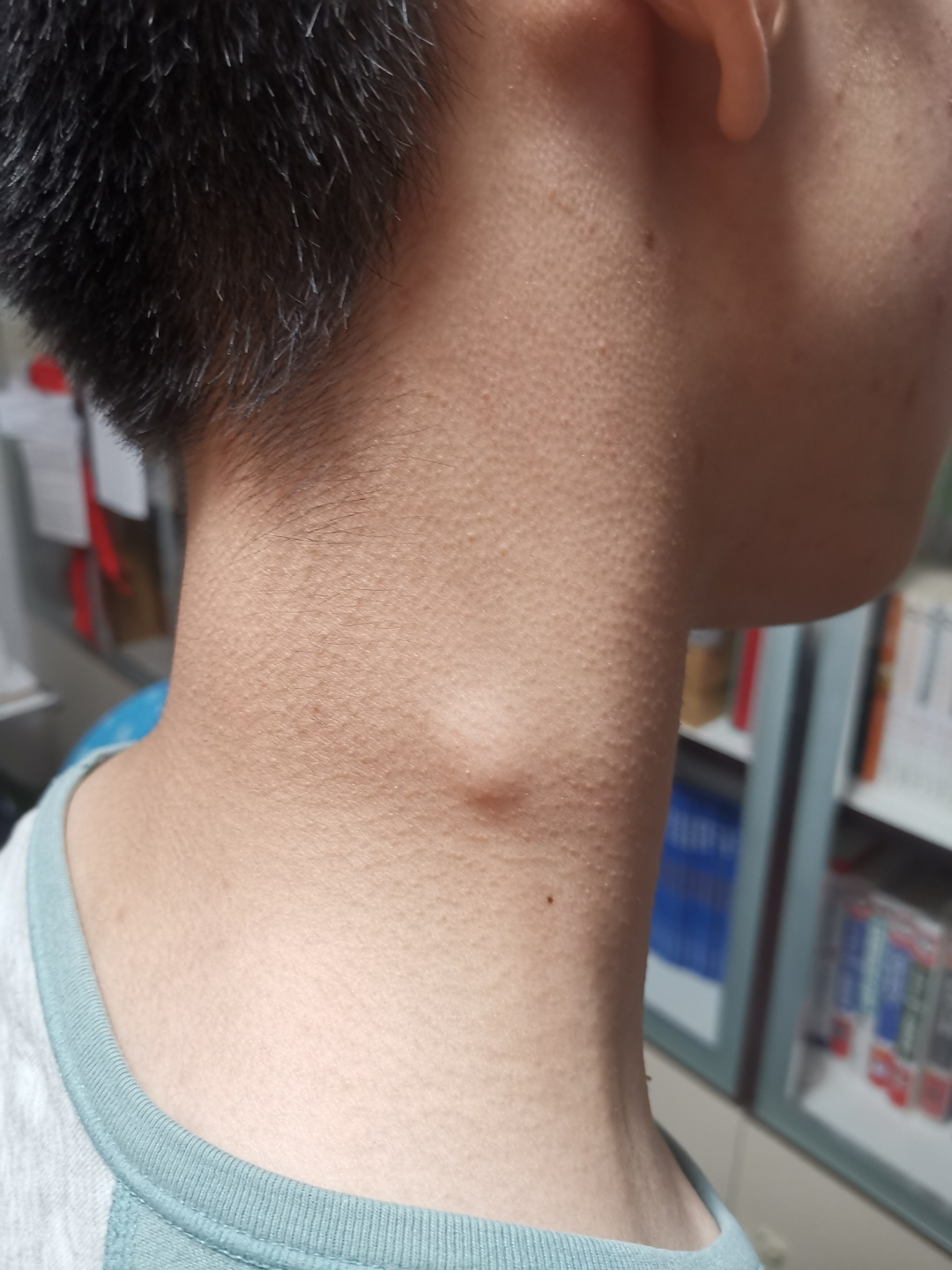 淋巴结  今天上午,小陈同学让我帮他看下案子这啥问题,说摸起来疼