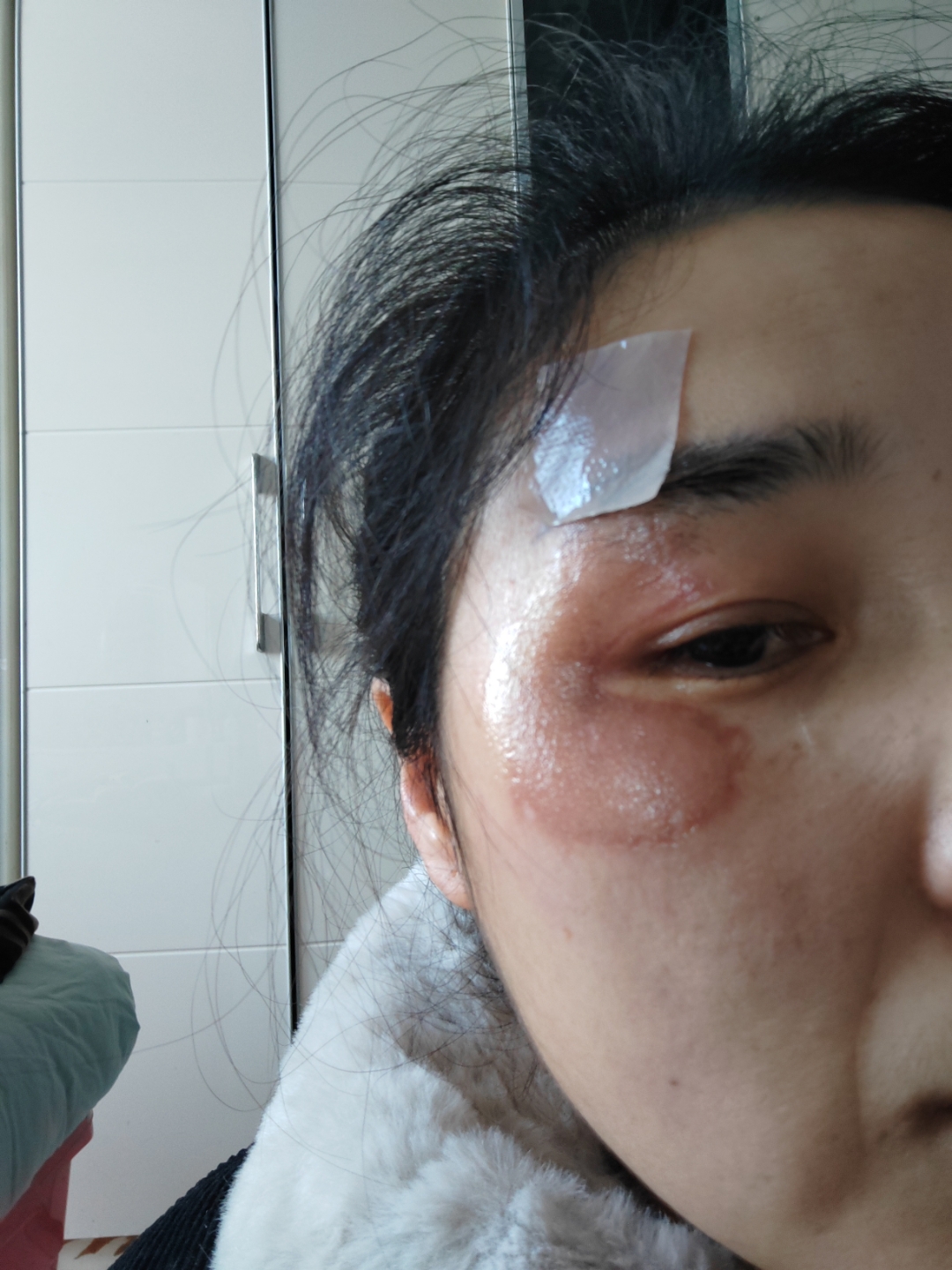 了,最后图片是掉痂后16天目前是暗红色,掉痂后在涂仁和牌疤痕修复凝胶