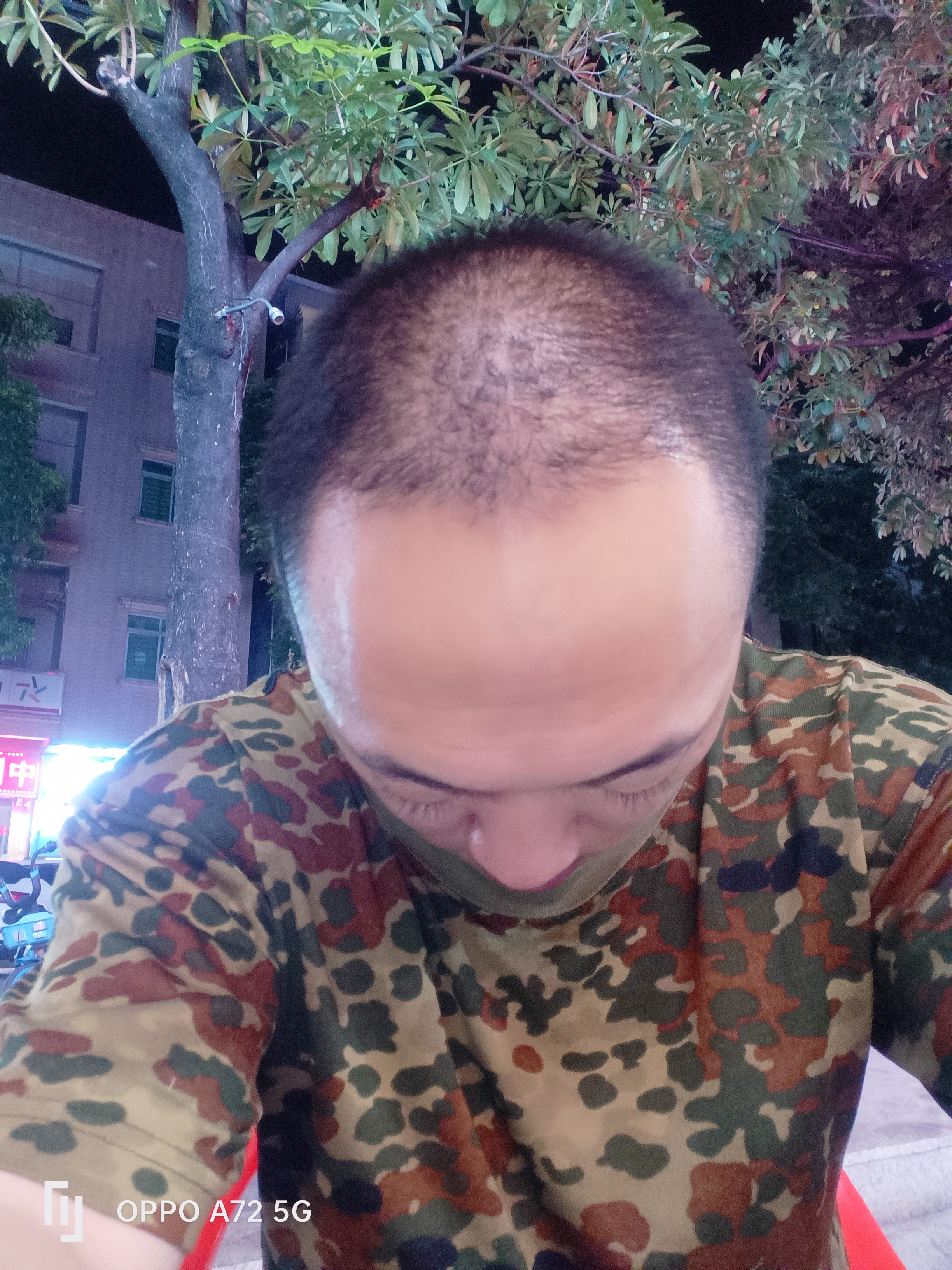 成都植发怎么植(成都植发吧 百度贴吧)