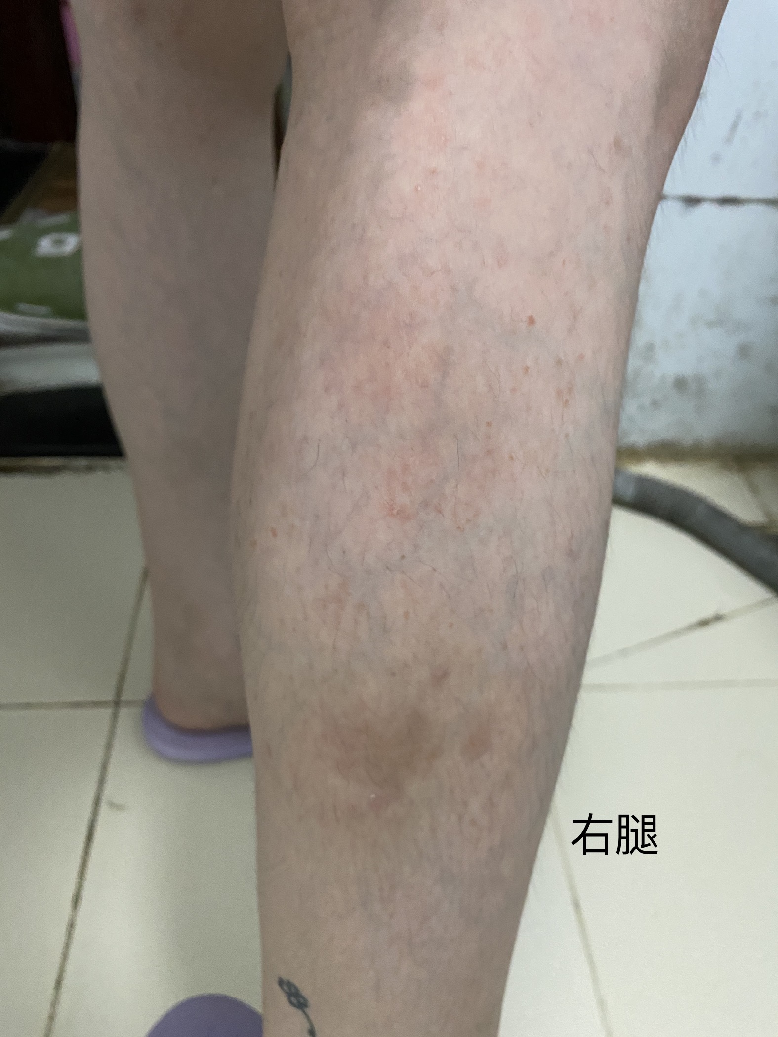 深圳市姑娘喝花美平茶27天的效果,腿上牛皮癣完全脱落了.