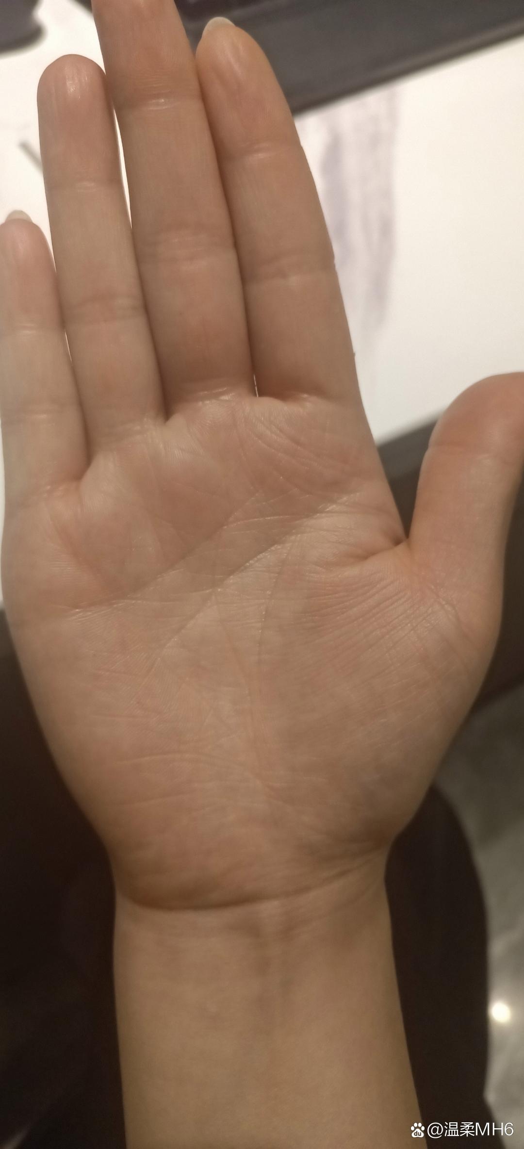 因为手背有颗黑痣,从小就被人说命不好,后面长大也感觉对运气不咋滴