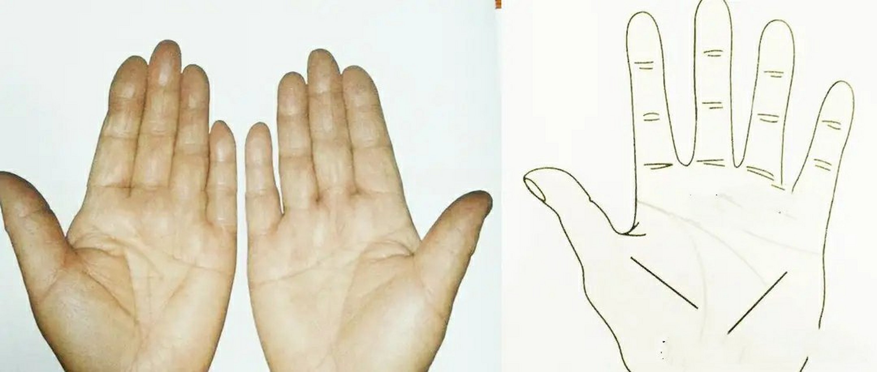 【倒八字】  倒八字:大鱼际出现一条竖纹,和亚健康线,形成八字.