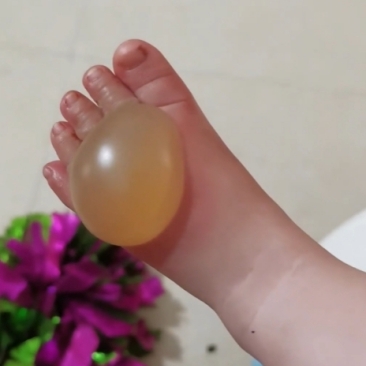 今天偶然间看到一个小宝贝的小脚被严重烫伤的画面,起了好大的泡,几乎