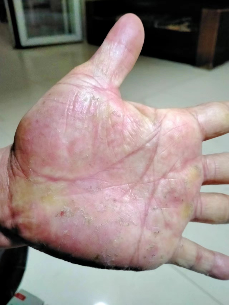 这种手上的皮肤病常见于长期接触水泥的工人,听说很难治.