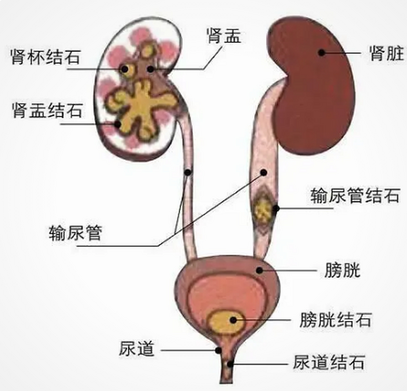 结石#输尿管结石#输尿管结石是泌尿结石中的一种,大部分患这个病的