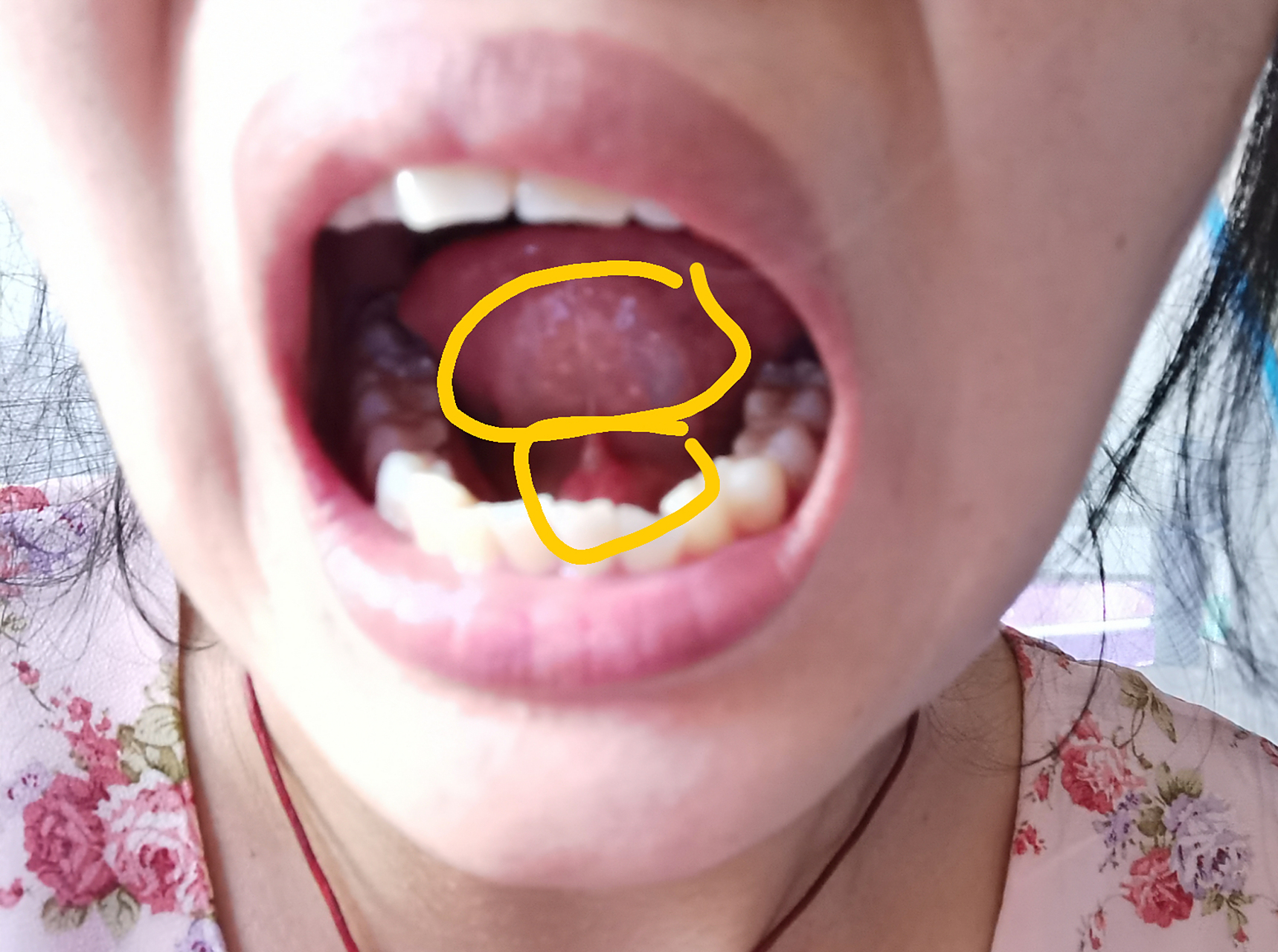 舌头底下白白的是什么?一粒一粒的