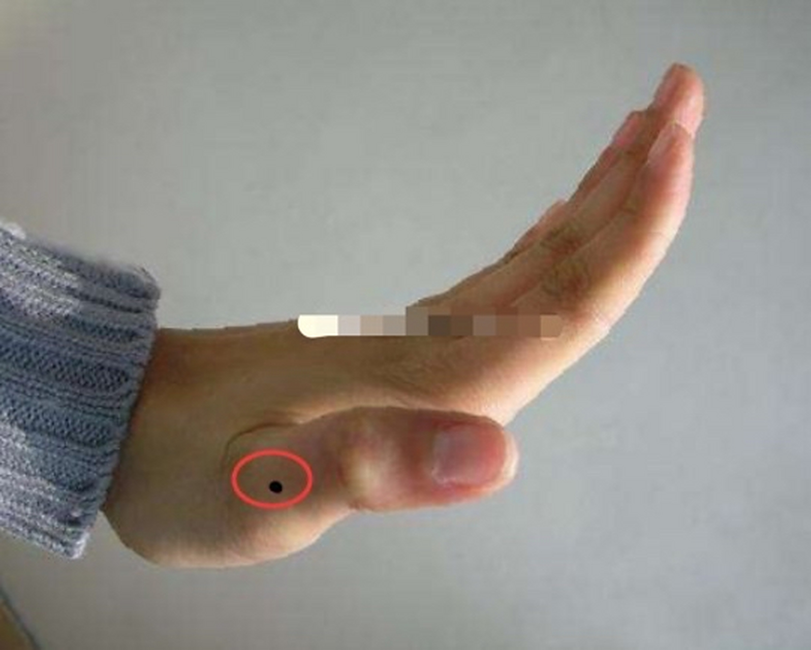 生在大拇指上的痣,在相学当中属于属于非常稀缺一颗痣.