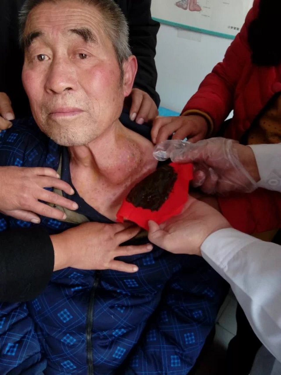 韩玉锁-肺癌转淋巴,颈部淋巴结肿大,现病情好转.运用中医独特疗法,扶