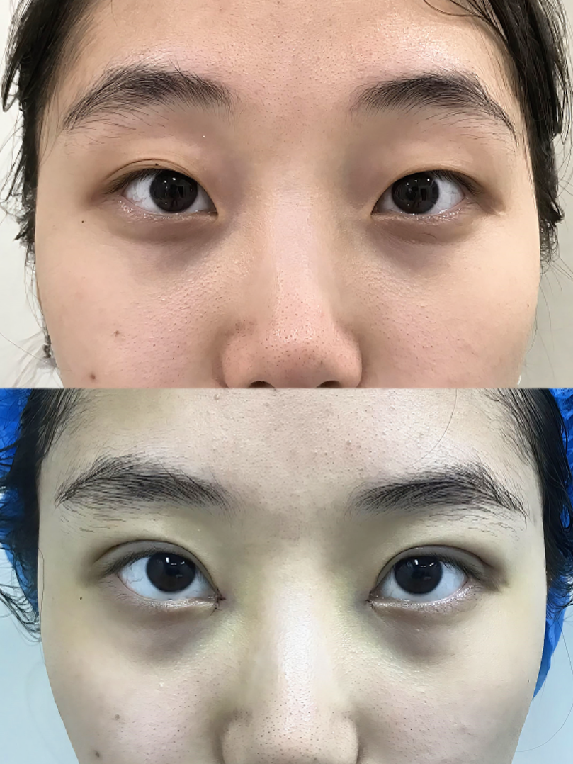 暑期变提肌双眼皮前后对比图片女孩双眼皮眼睛有神与无神图片