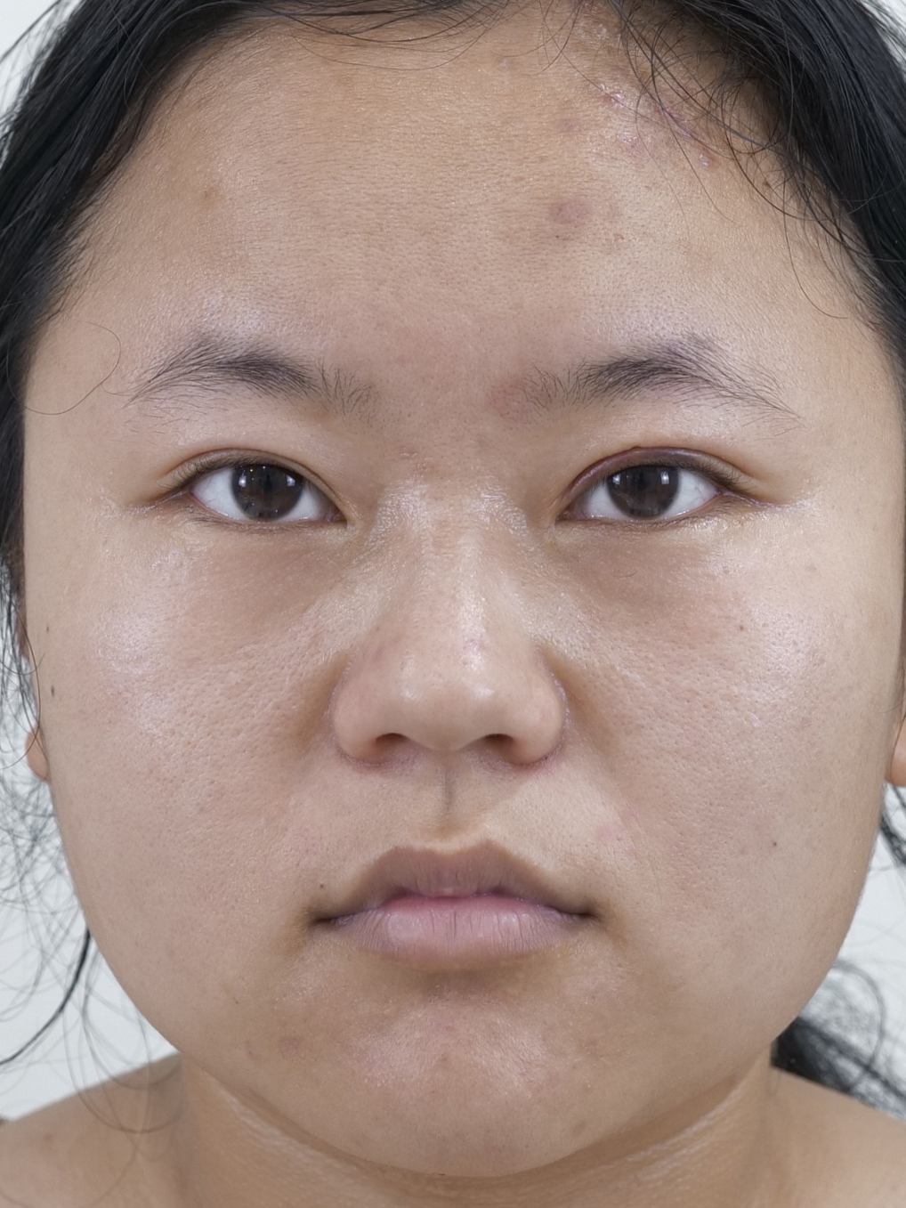 小姑娘双眼皮其实没啥大毛病,就一侧双眼皮看着内宽外窄的,有点影响