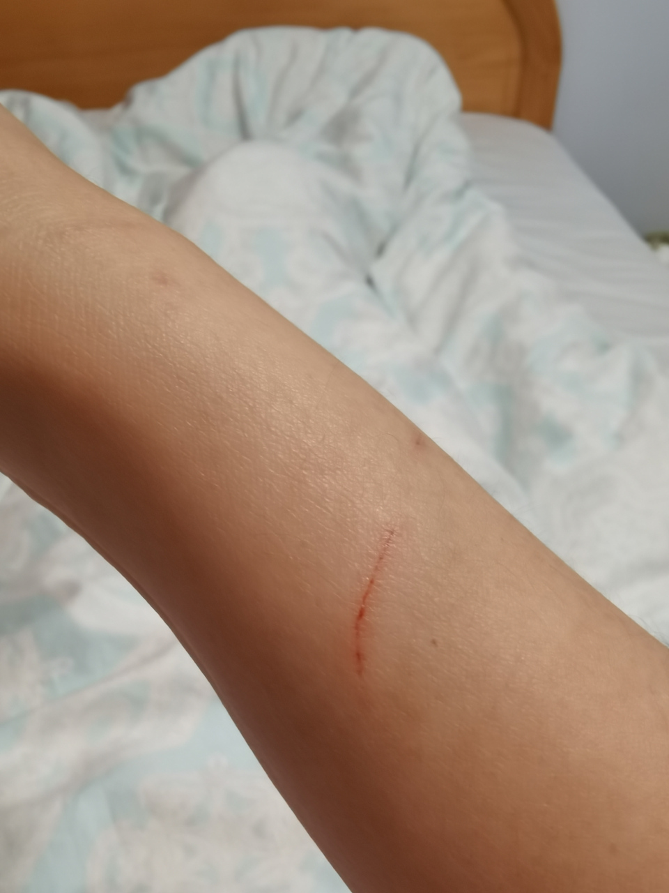 被自己家的猫抓伤了,出了血,不准备去打狂犬疫苗了.