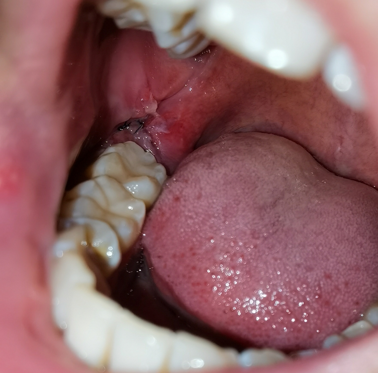 拔牙第四天,看着好恐怖