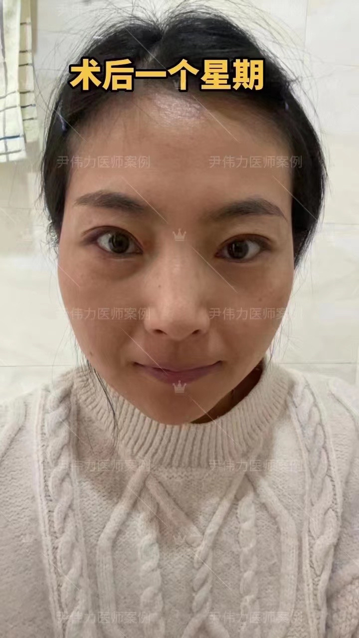 术后七天拆线后[强]:术前肉条感明显 眼窝轻微凹陷  假宽深  闭眼痕迹