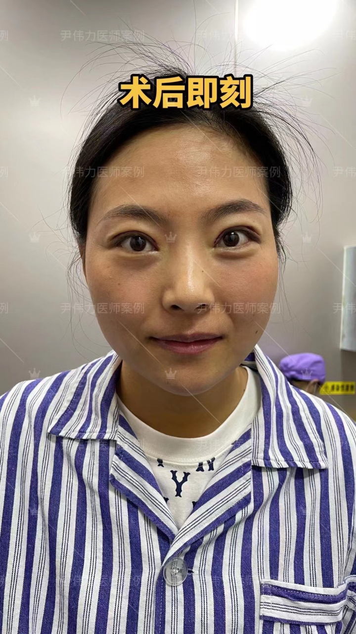 术后七天拆线后[强]:术前肉条感明显 眼窝轻微凹陷  假宽深  闭眼痕迹