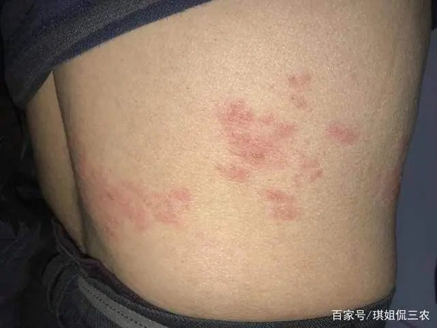 蛇缠腰 丹毒,又名龙缠腰,缠火龙. 两位食物就能治好!