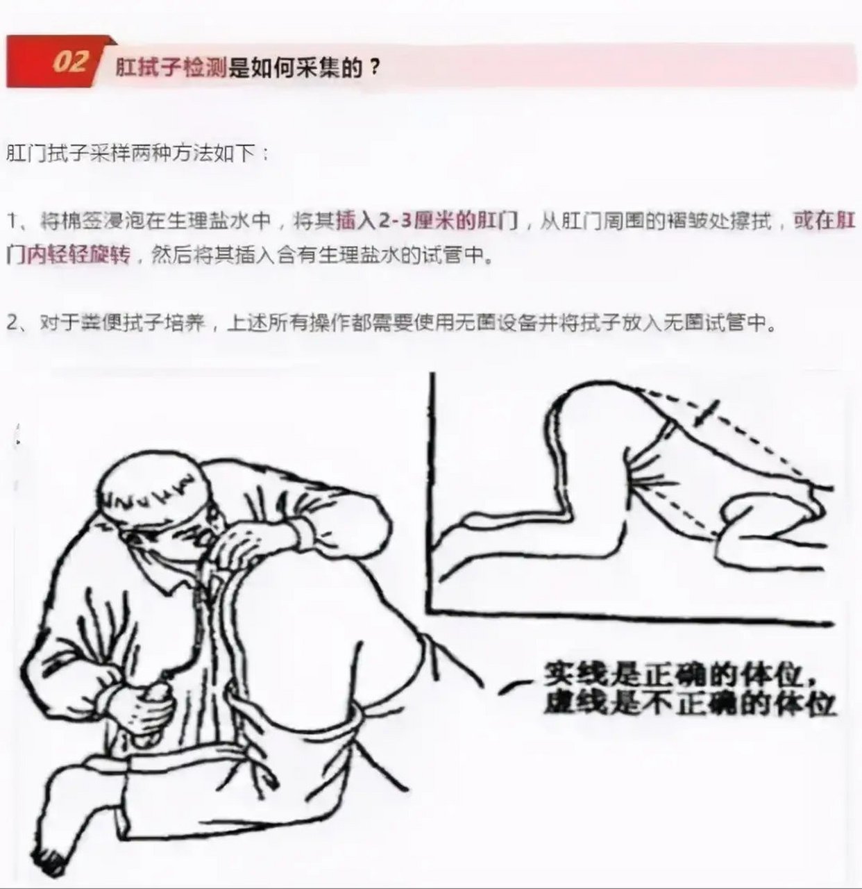 就是将取样拭子插入肛门,在肛门周围的皱褶处擦拭取样,以便检测出病原
